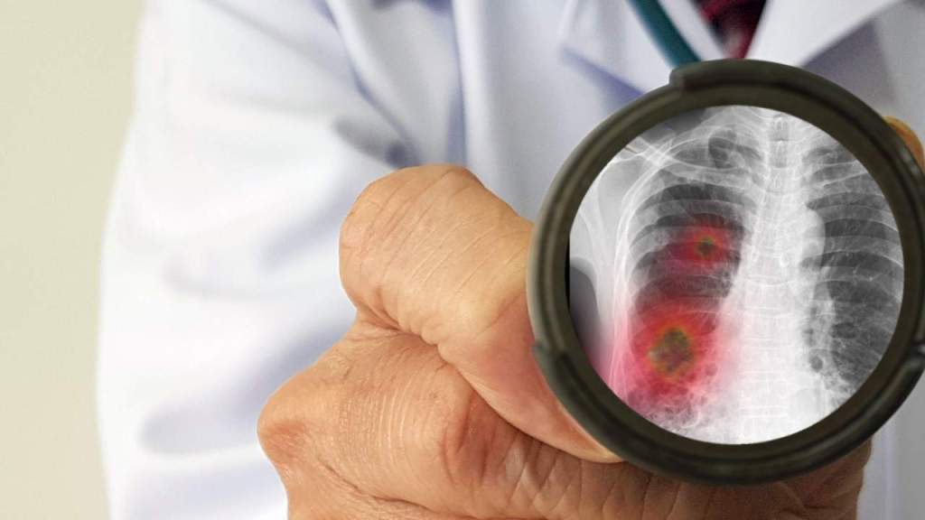 Inhaled drug shows promise in coronavirus&nbsp;treatment