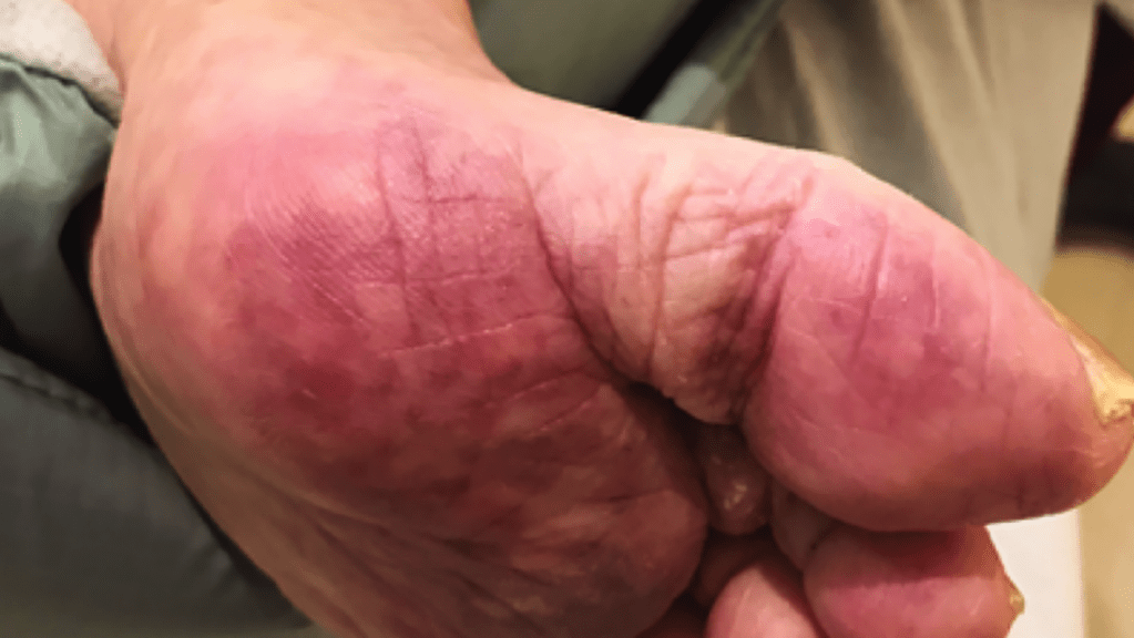 Evidence of coronavirus-related skin lesions, discoloration, rash supported by new&nbsp;study