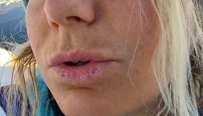 How To Treat Sunburned&nbsp;Lips