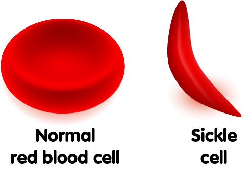 sickle cell anemia