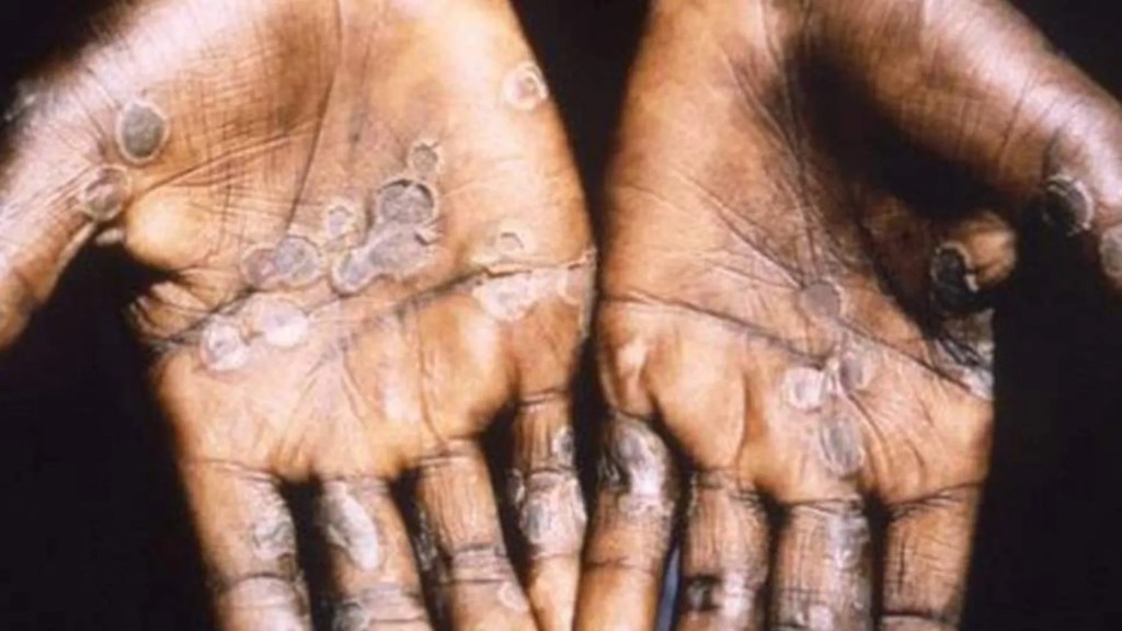UK confirms more cases of&nbsp;monkeypox