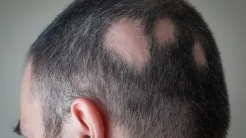 Drug to treat alopecia approved by&nbsp;FDA