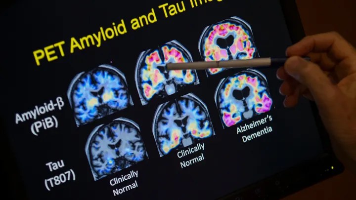 FDA accelerates approval for Alzheimer’s&nbsp;drug